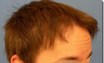 Hair restoration procedure results