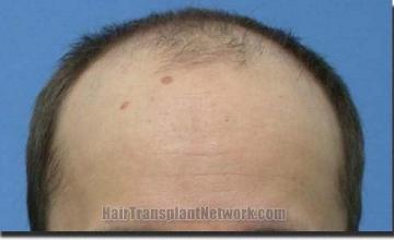 Hair restoration procedure results