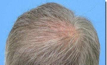 Hair restoration procedure results