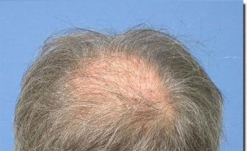 Hair restoration procedure results