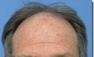 Hair restoration procedure results