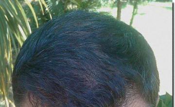 Hair restoration procedure results