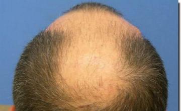 Hair restoration procedure results