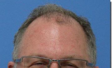 Hair restoration procedure results