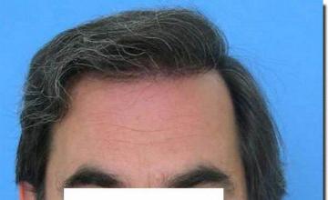 Hair restoration procedure results