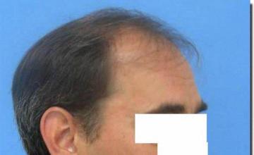 Hair restoration procedure results