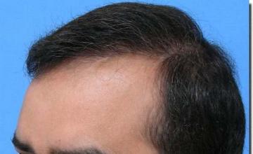 Hair restoration procedure results