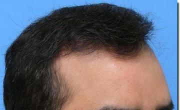 Hair restoration procedure results