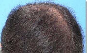 Hair restoration procedure results