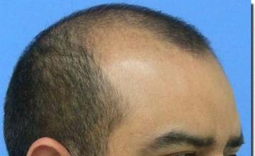 Hair restoration procedure results