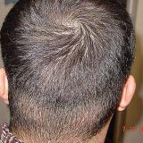 Follicular Unit Transplantation (FUT)