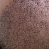 Ultra Refined Follicular Unit Grafting