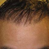 How to Pick a Hair Restoration Physician