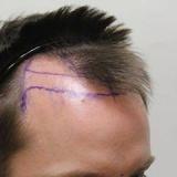 FUE Hair Transplant Introduction 