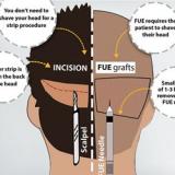FUT vs FUE Hair Transplant