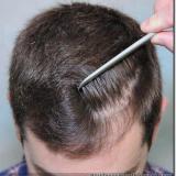 Hair transplantation FAQs