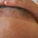 Hair transplant growth stages