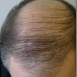 Hair Transplant Repair