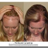 Hairline Lowering Procedures for Women with a High Forehead