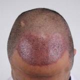 FUE Punches: Sharp Versus Blunt Punches