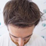 Medical hair restoration - is it right for you?