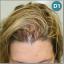 Female Hair loss Treatment and Solutions