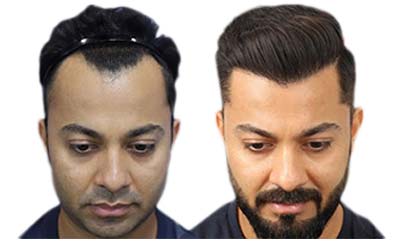 World's best hair deals transplant